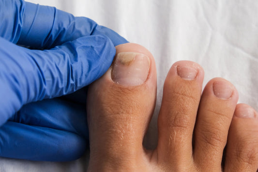 How to treat athlete's foot?
